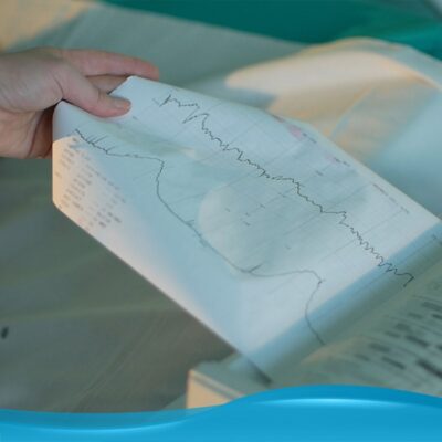 Image of a CTG chart for illustration purposes.